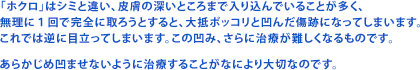 「ホクロ」はシミと違い、皮膚の深いところまで入り込んでいることが多く、
無理に1回で完全に取ろうとすると、大抵ポッコリと凹んだ傷跡になってしまいます。
これでは逆に目立ってしまいます。この凹み、さらに治療が難しくなるものです。
あらかじめ凹ませないように治療することがなにより大切なのです。