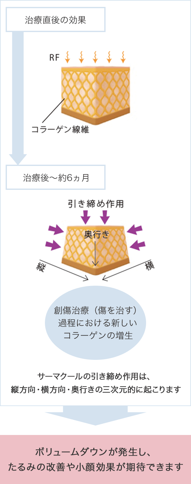 治療直後の効果⇒治療後～約6ヵ月　創傷治療（傷を治す）過程における新しいコラーゲンの増生 サーマクールの引き締め作用は、縦方向・横方向・奥行きの三次元的に起こります。ボリュームダウンが発生し、たるみの改善や小顔効果が期待できます。