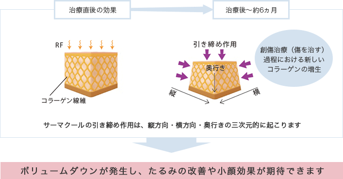 治療直後の効果⇒治療後～約6ヵ月　創傷治療（傷を治す）過程における新しいコラーゲンの増生 サーマクールの引き締め作用は、縦方向・横方向・奥行きの三次元的に起こります。ボリュームダウンが発生し、たるみの改善や小顔効果が期待できます。