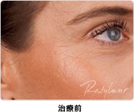 ビタールライト注入治療前