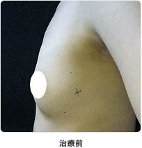 治療前