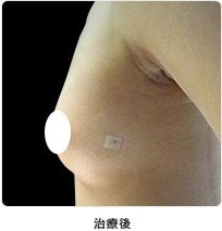 治療後
