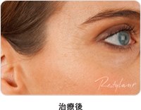 治療後