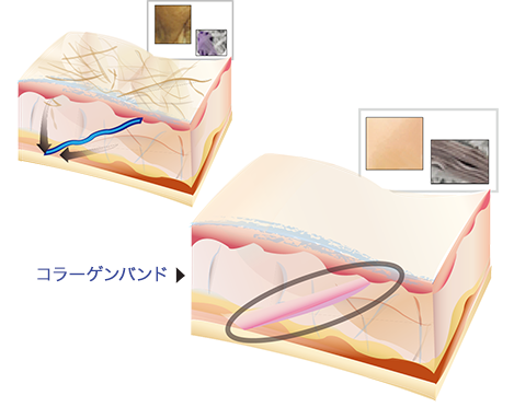 コラーゲンバンドのイメージ