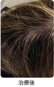 Dr.CYJヘアフィラー（毛髪再生注入剤）（レーザー治療） | 恵比寿院 