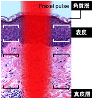 フラクセル照射スタート