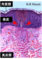 フラクセル照射6～8時間後