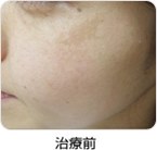 治療前