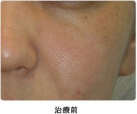 頬の毛穴 5回治療治療前