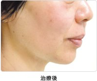 頬のたるみ 5回治療治療後