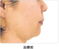 頬のたるみ 5回治療治療前