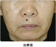 頬のたるみ・小ジワ 5回治療治療後