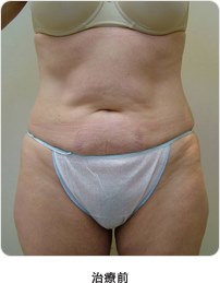腹部7回治療治療前