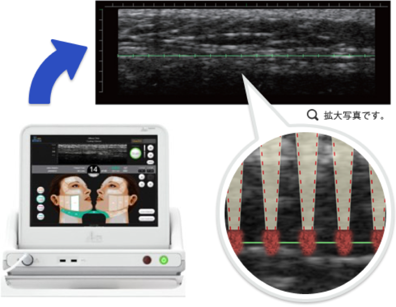 ウルセラの超音波画像診断機能のイメージ1