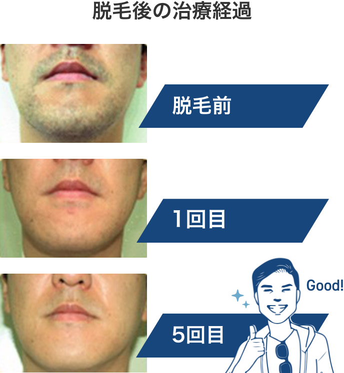 医療脱毛後の治療経過