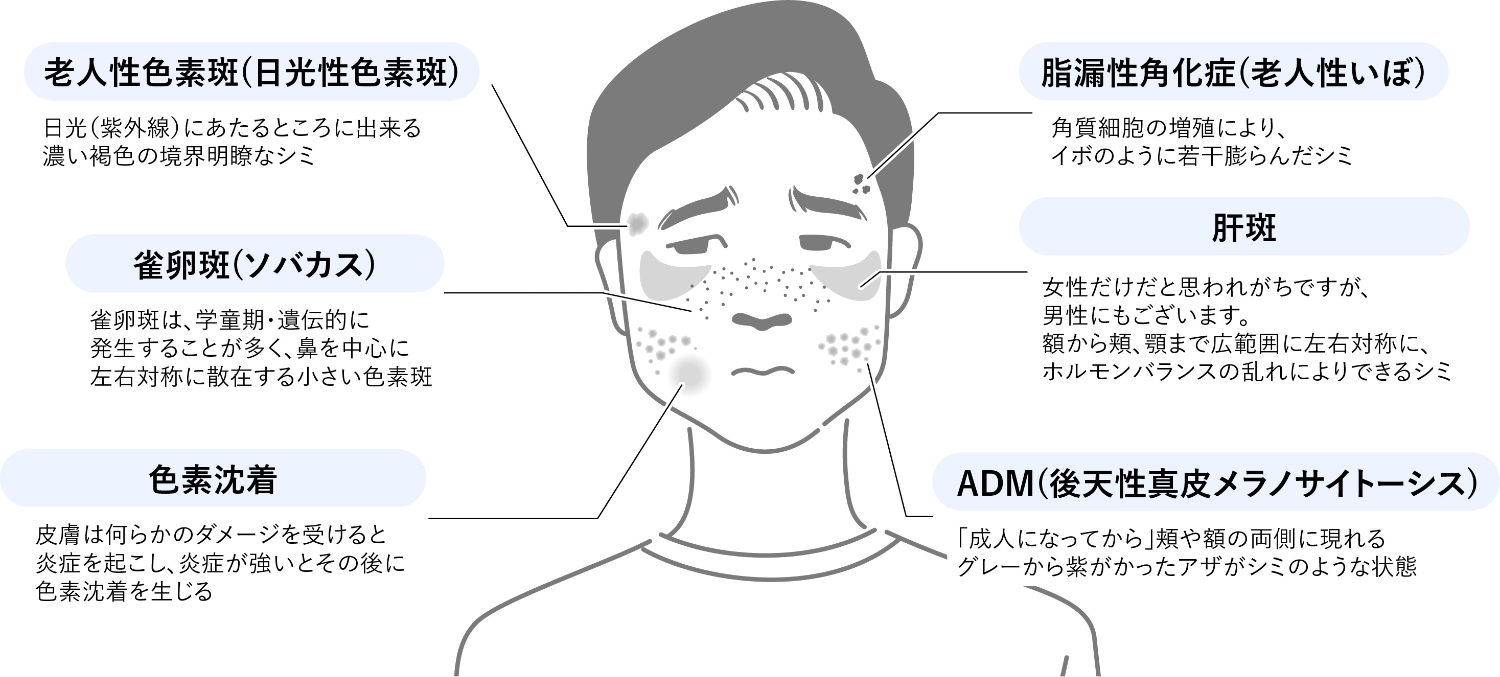 しみの原因・種類について