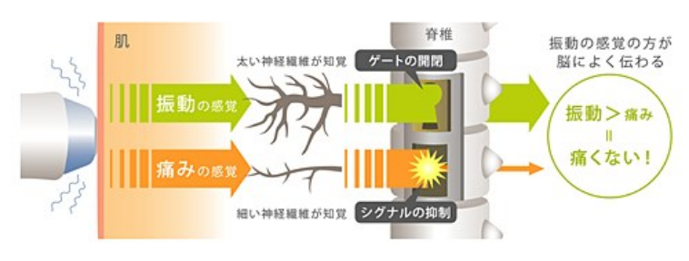 サーマクールCPTは痛みが少ない