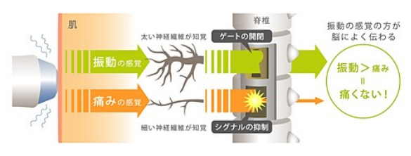 サーマクールFLXは痛みが少ない