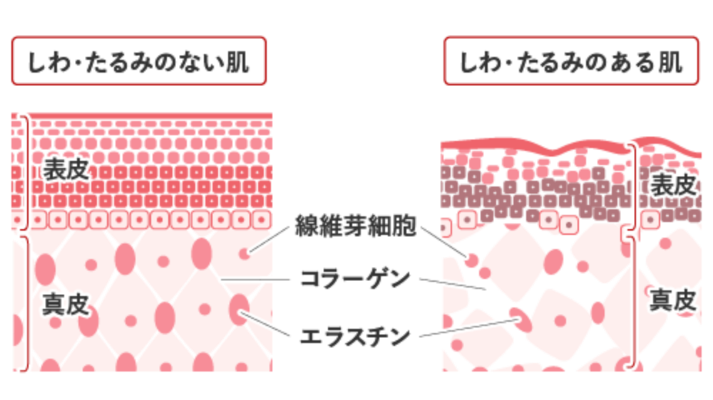 しわたるみのある肌とない肌の違い