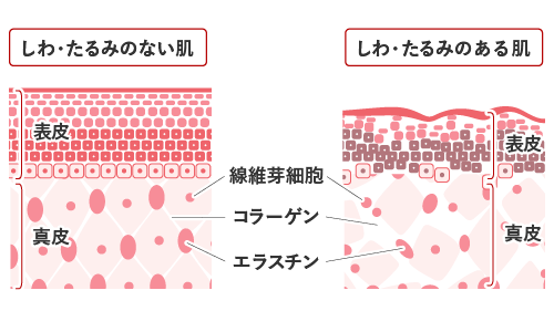 たるみの原因