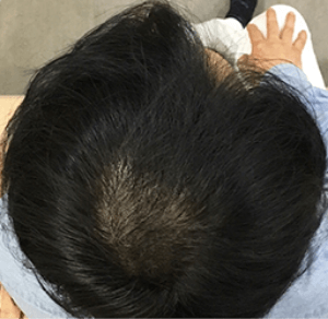 アートヘア（ヘアアートメイク）　2回目施術後