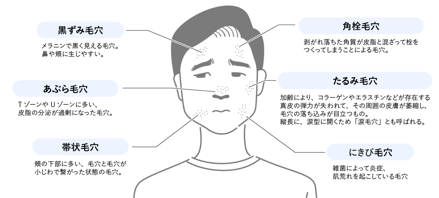 毛穴の原因・種類について