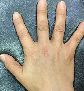 手の甲のしわ(ふっくら、しわを薄くする)治療前