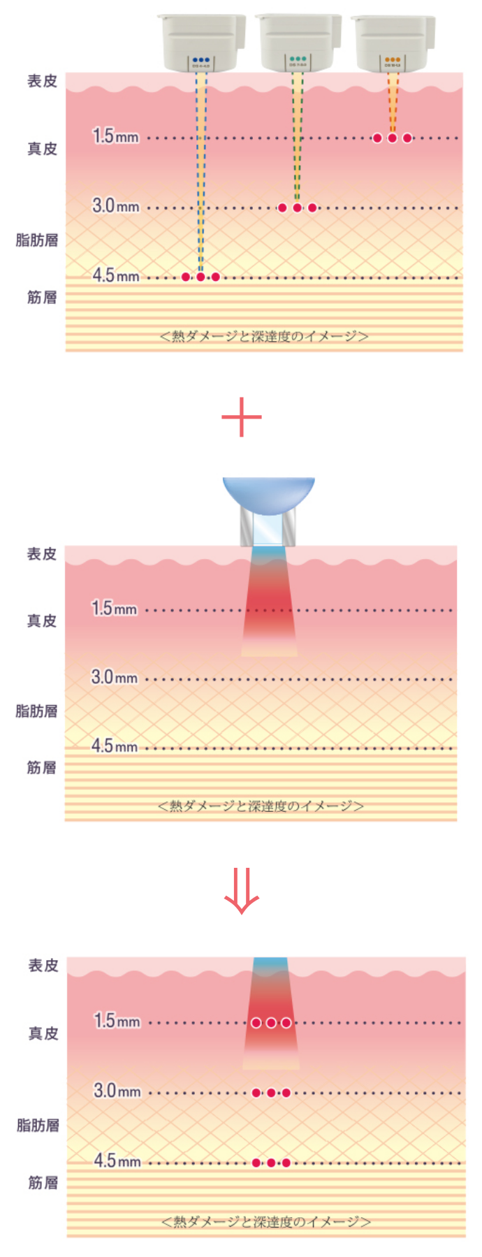 ウルセラ ＋ 光・レーザー治療