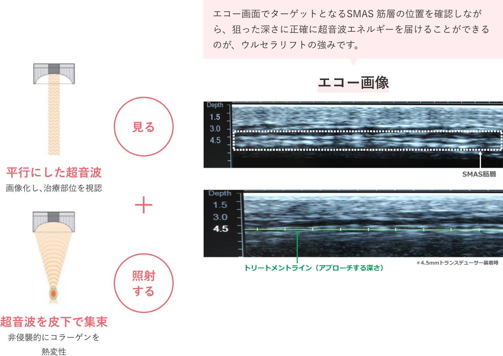 超音波で「見ながら、狙った深さにエネルギーを届ける」