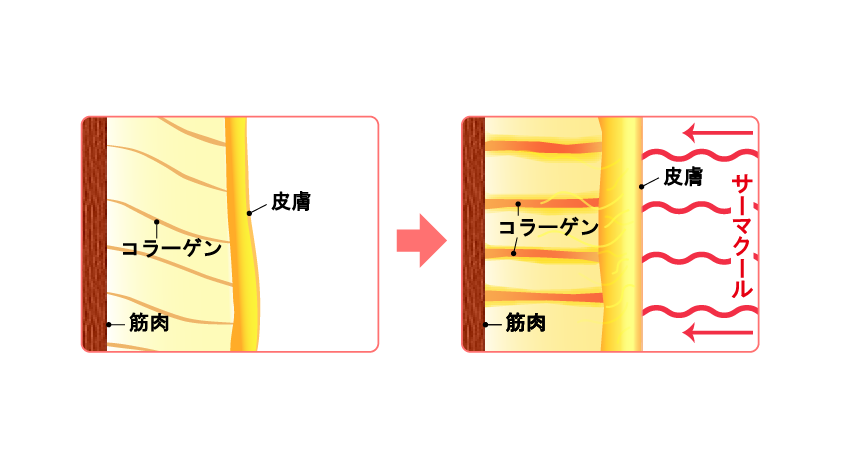 サーマクールボディのメガニズム2