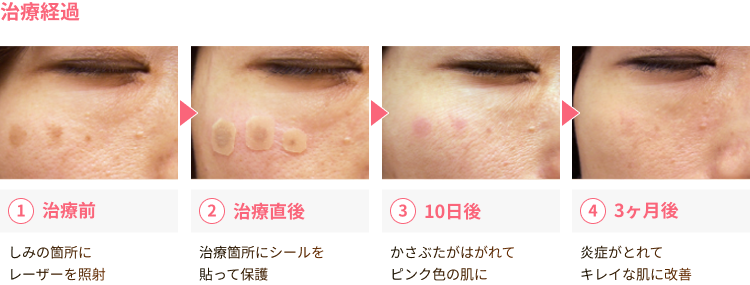 しみ 治療（レーザー治療）｜美容皮膚科シロノクリニック | 恵比寿院 