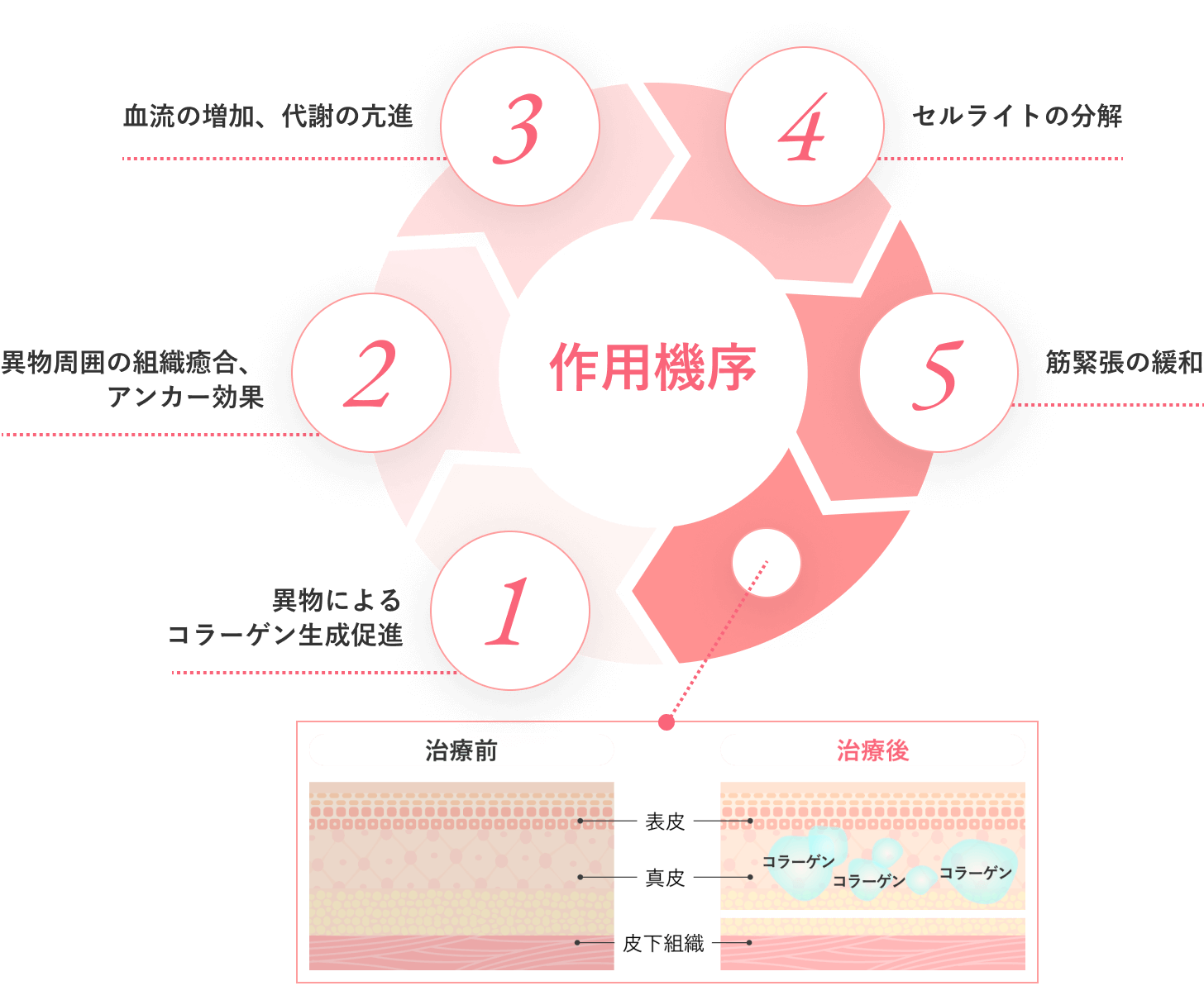 ショートスレッドの作用