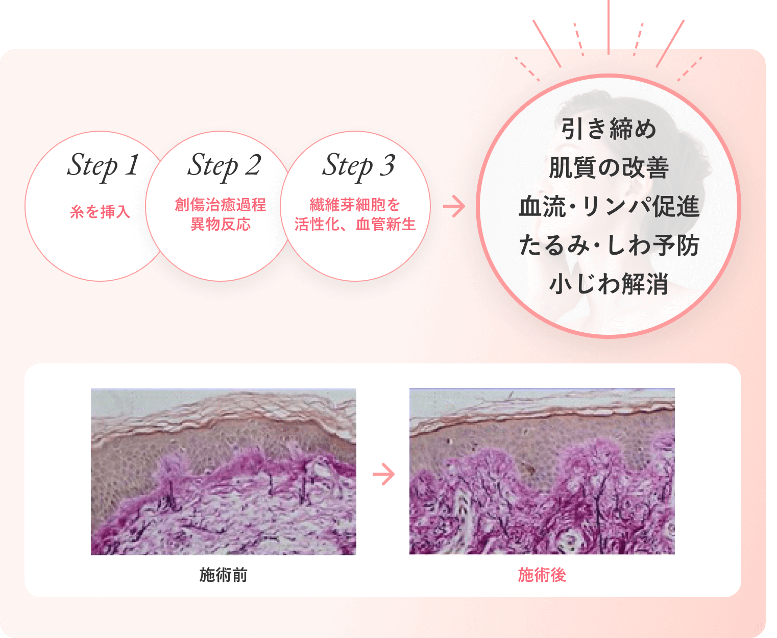 ショートスレッドの作用