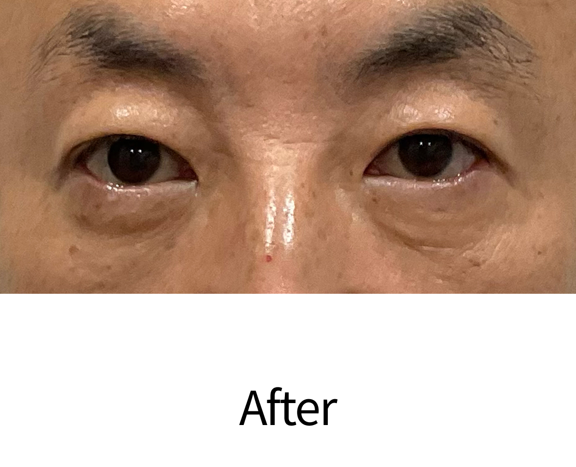 目のたるみ・クマ取り治療（経結膜脱脂術）治療後