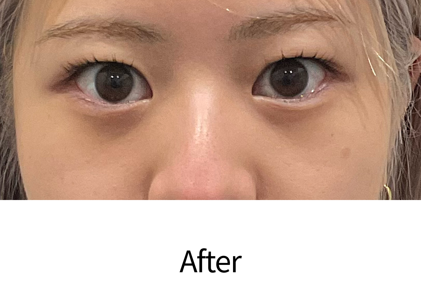 目のたるみ・クマ取り治療（経結膜脱脂術）治療後
