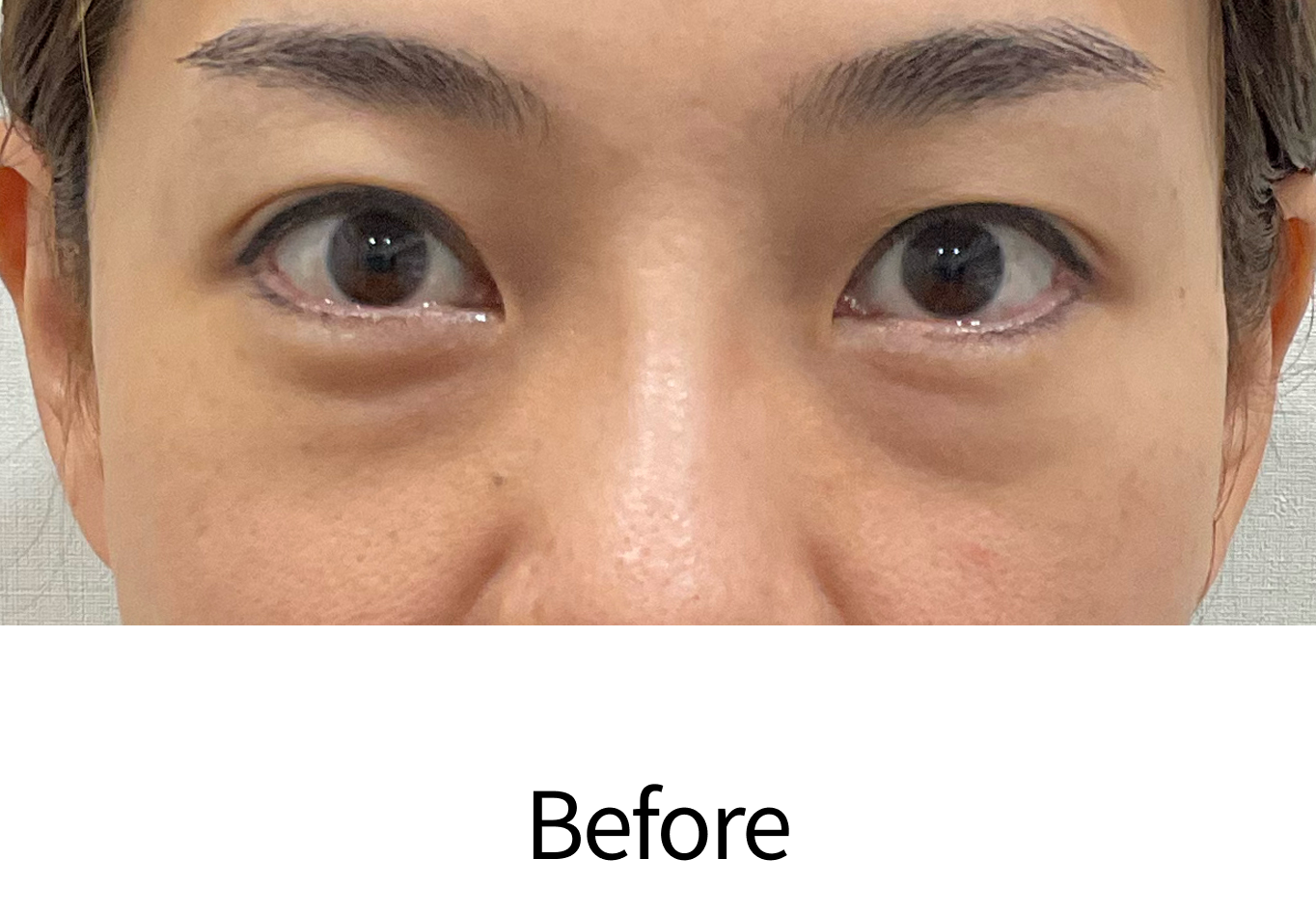 目のたるみ・クマ取り治療（経結膜脱脂術）治療前