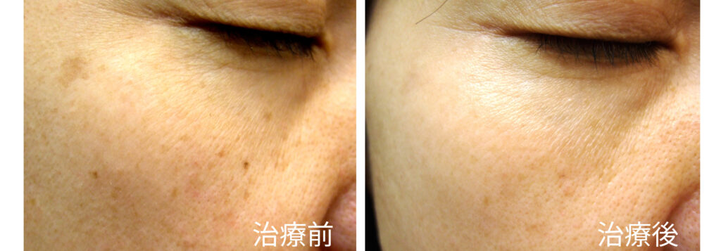 治療前後