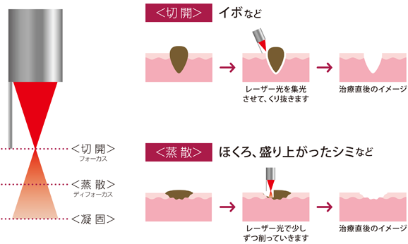 炭酸ガスレーザーの特長2