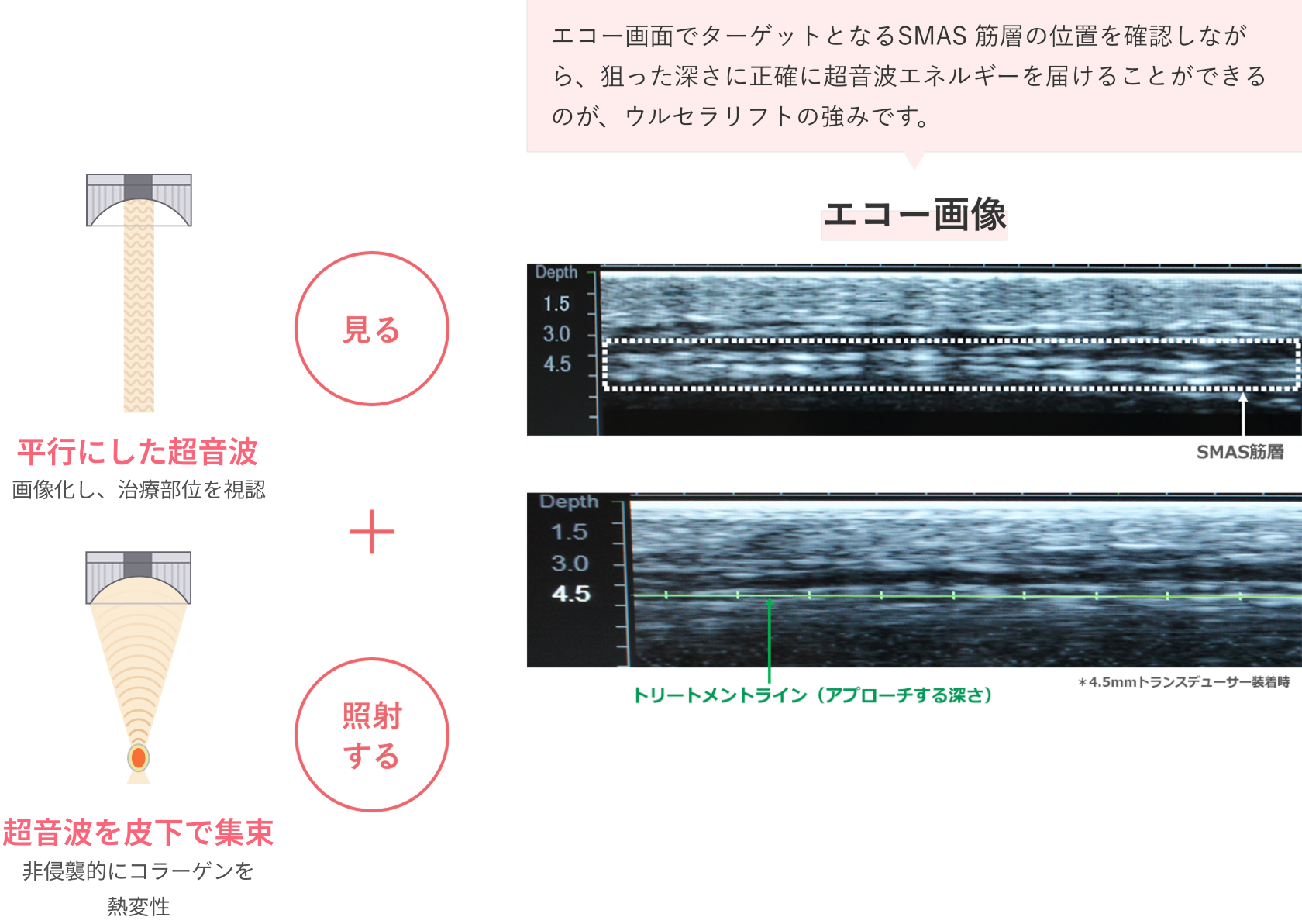 超音波で「見ながら、狙った深さにエネルギーを届ける」