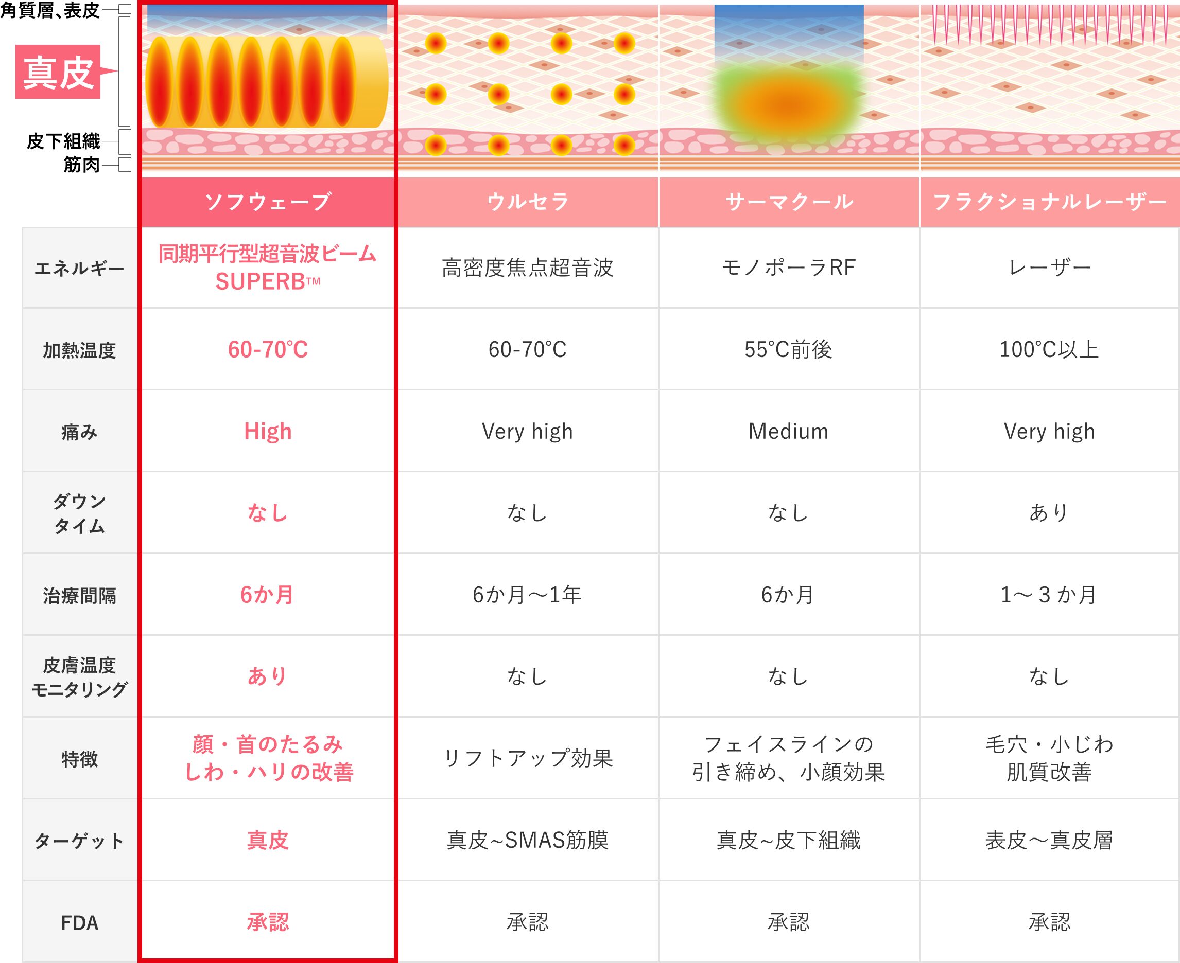 ソフウェーブとその他たるみ治療の比較