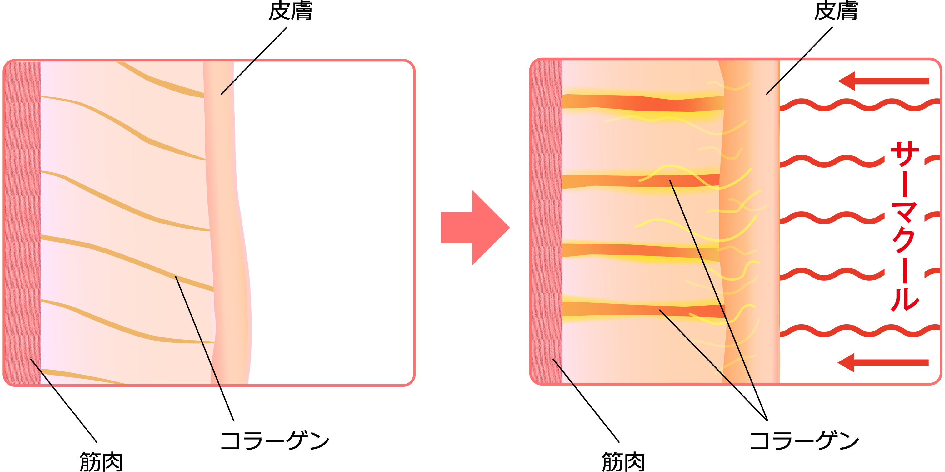 サーマクールボディのメガニズム2