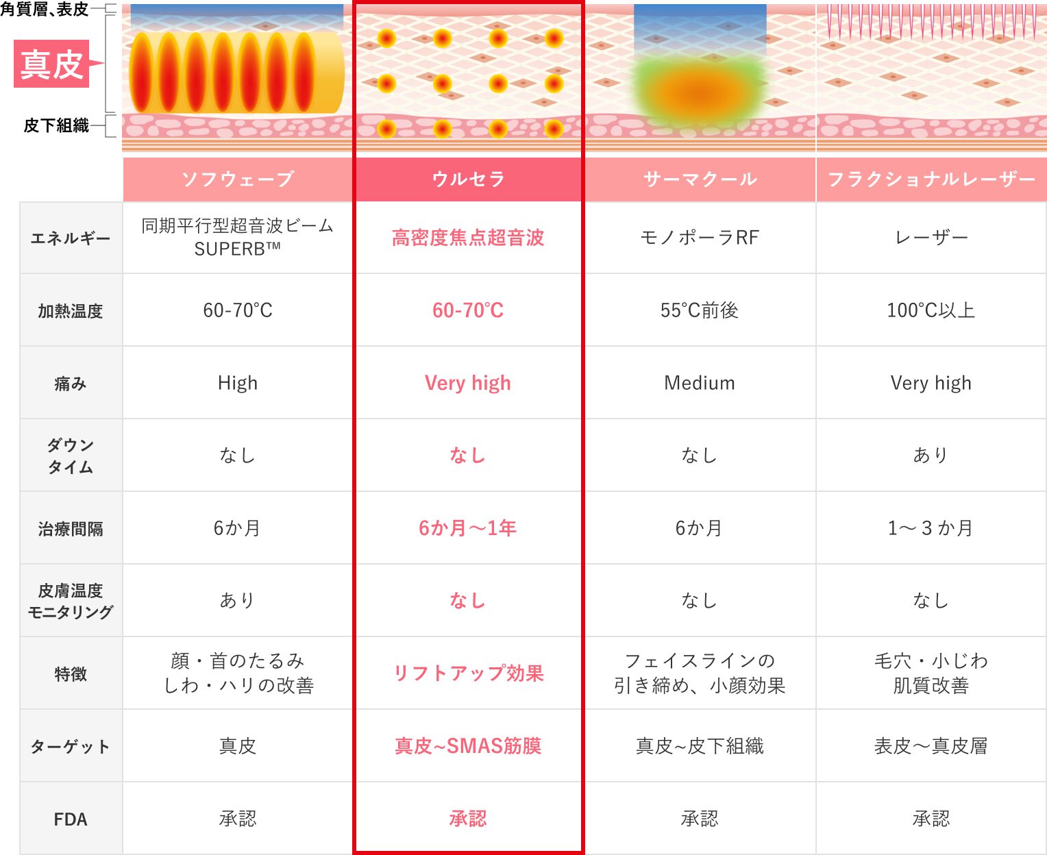 ウルセラとその他たるみ治療の比較