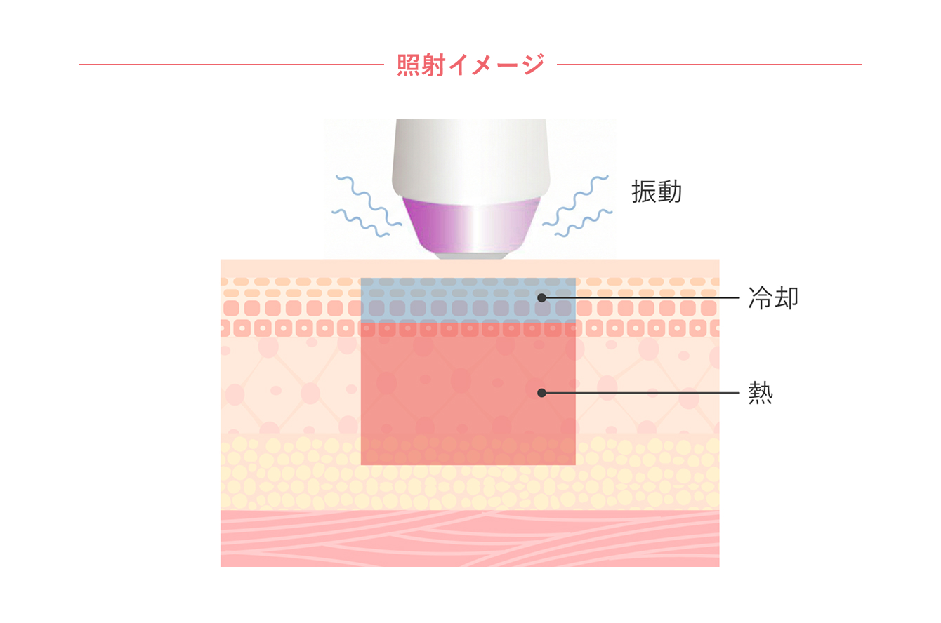 サーマクールFLX｜美容皮膚科シロノクリニック｜恵比寿院(東京都渋谷区)