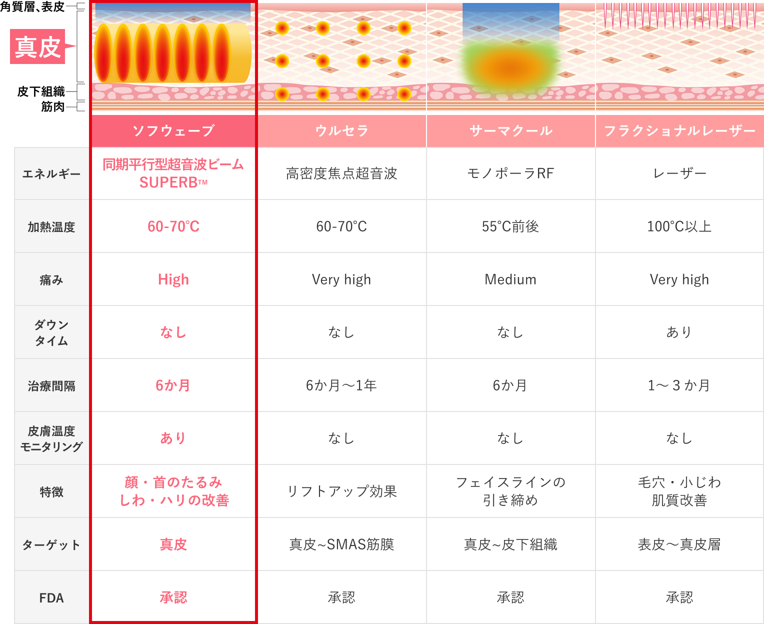 ソフウェーブとその他たるみ治療の比較