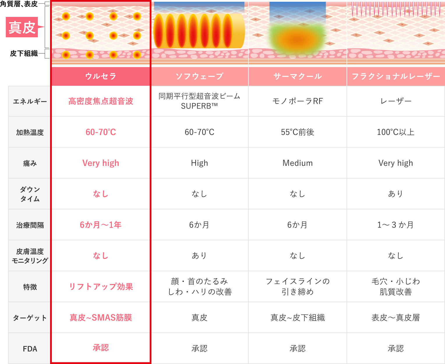 ウルセラとその他たるみ治療の比較