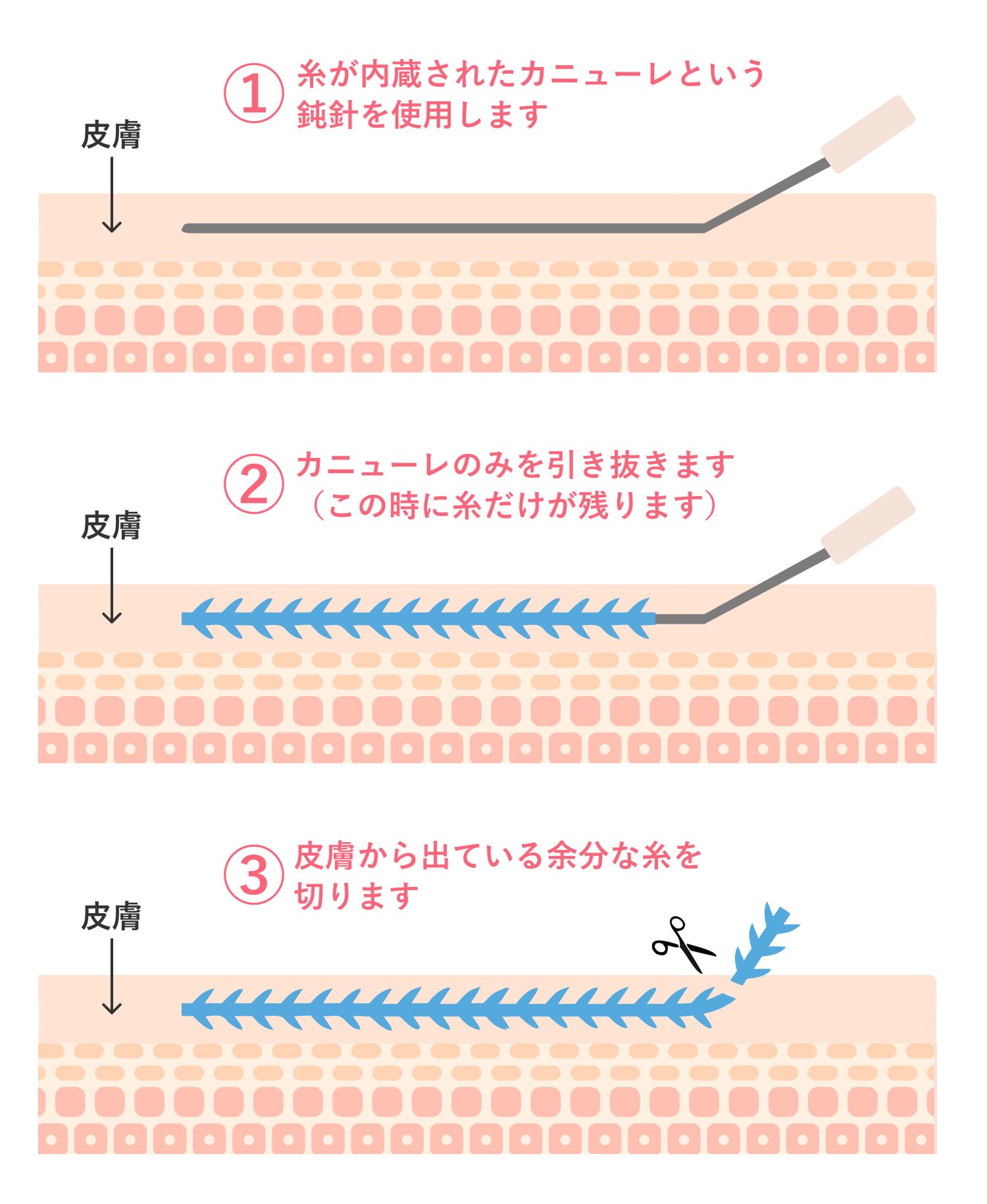 糸が内蔵されたカニューレという鈍針を使用します