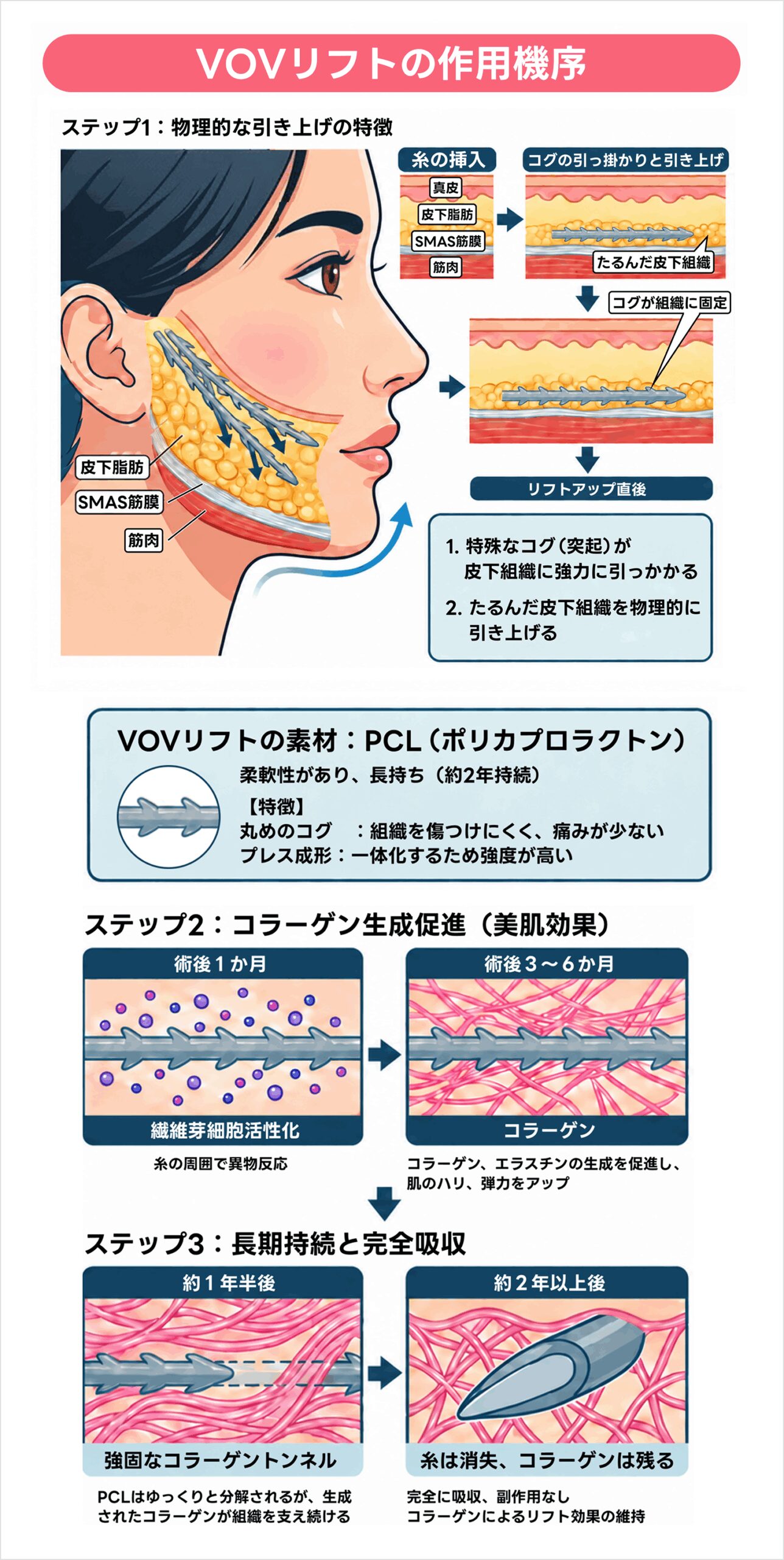 VOVリフトの作用機序