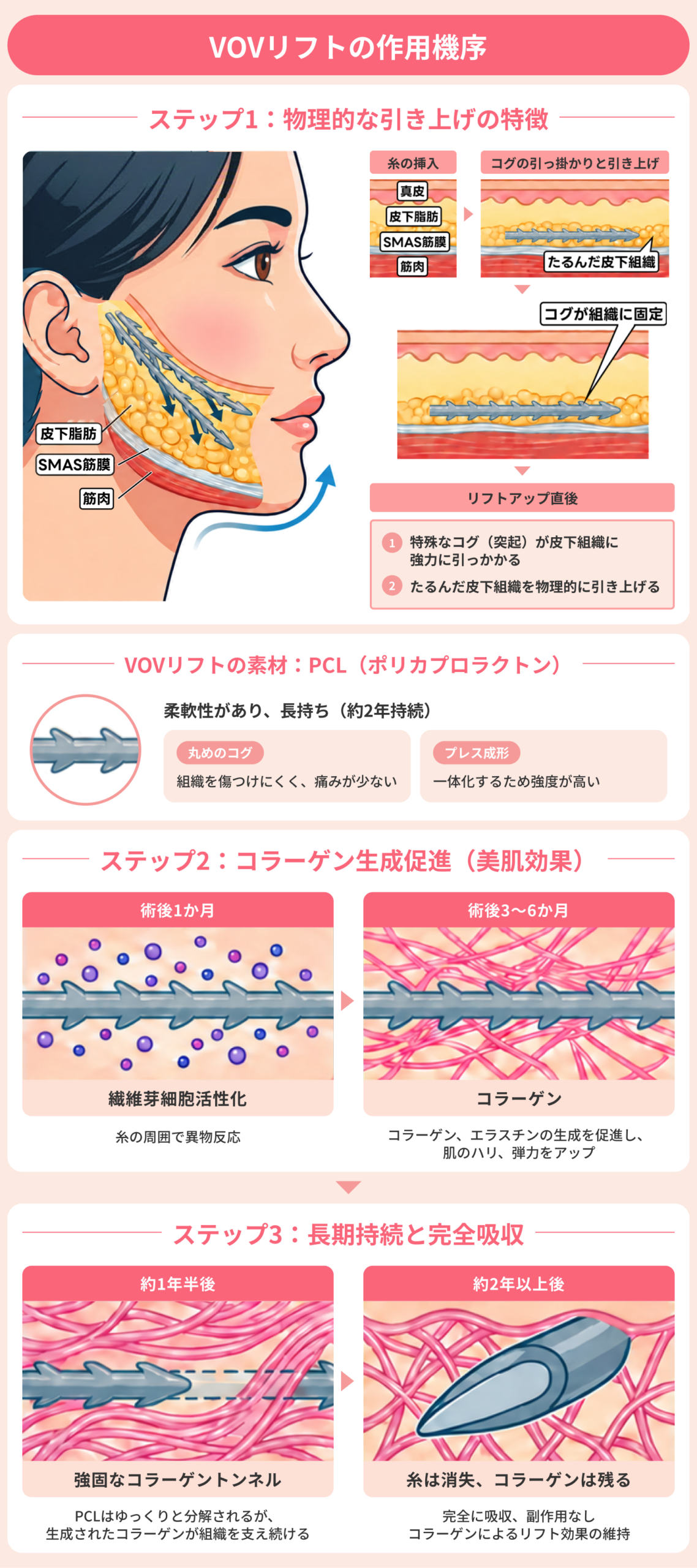 VOVリフトの作用機序